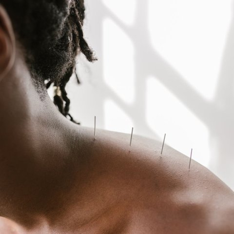 Acupuncture